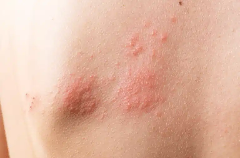 Todo sobre el Herpes Zóster: Causas, Síntomas y Tratamientos Naturales