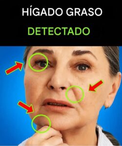 Todos con hígado graso tienen esto en común