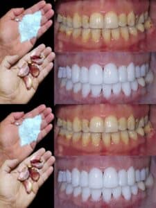COmo blanquear los dientes en dos minutos