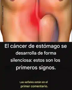 Cáncer de Estómago (Gástrico)