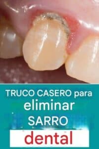 Consejo casero para eliminar el sarro tú mismo