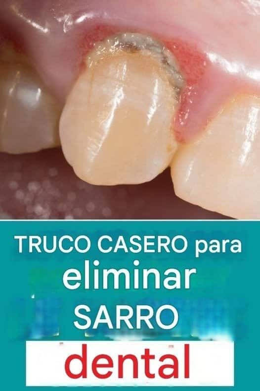 El mejor consejo casero para eliminar el sarro tú mismo eficazmente