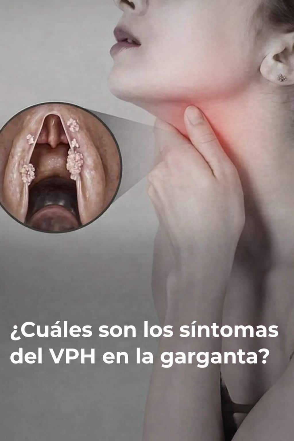 ¿Cuáles son los síntomas del VPH en la garganta?