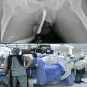 La endometriosis también puede provocar dolor durante o después de las relaciones sexua