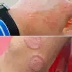 Pelos Encarnados y Foliculitis