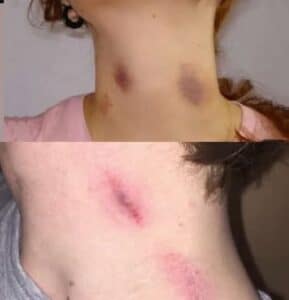 Si tu pareja te hace estos “chupetones”, esto es lo que realmente significa