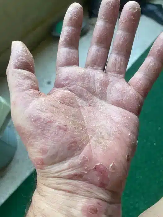 Síndrome de Sweet: Guía sobre Causas, Síntomas y Tratamiento Completo