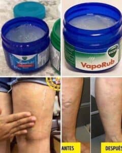 Tengo 35 años y mis muslos y piernas estaban llenas de Várices