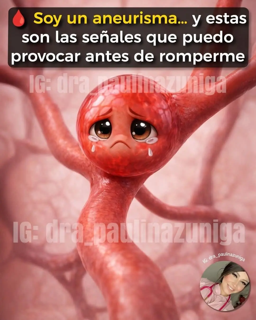 Aneurisma señales riesgos y detección temprana