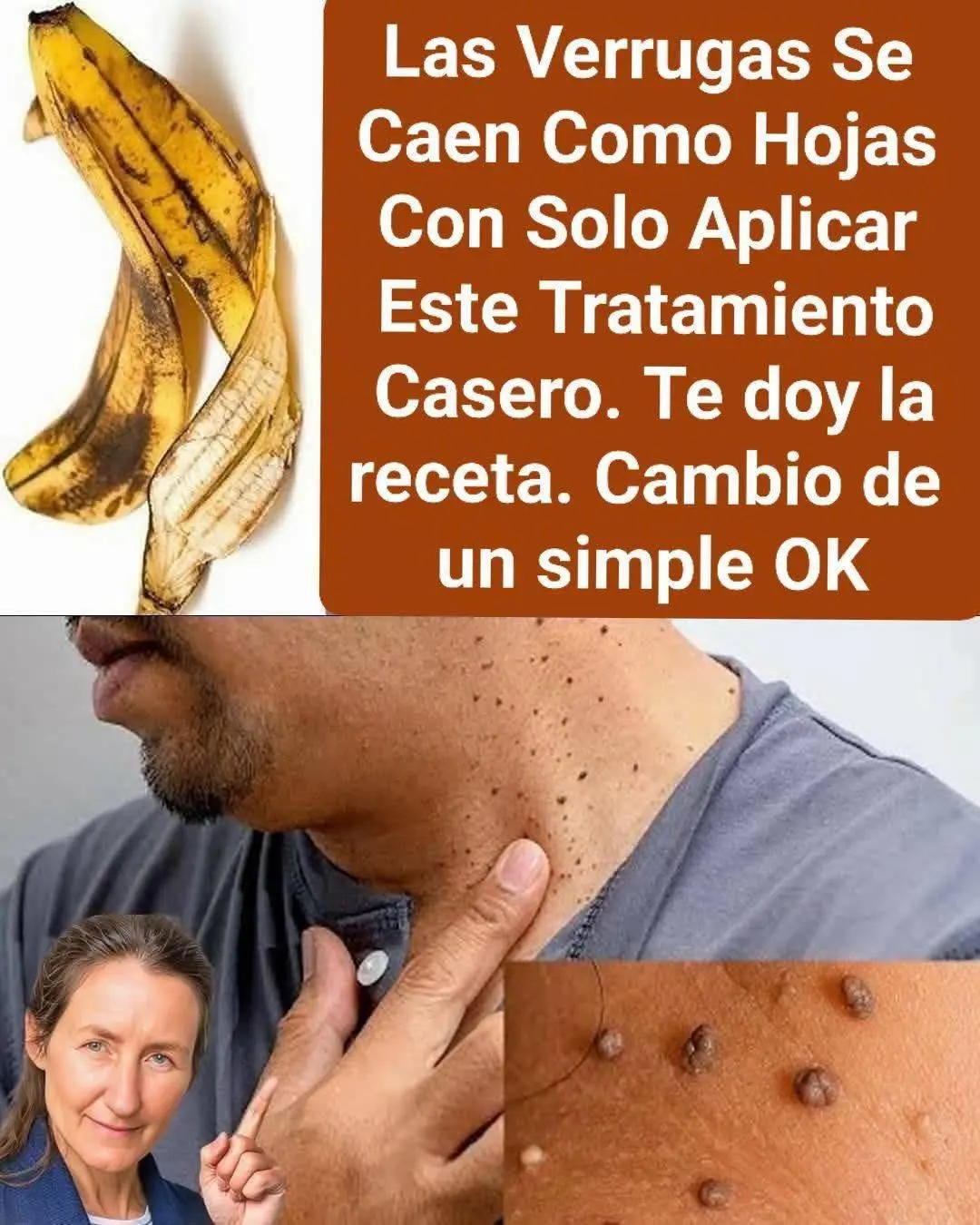 Remedios naturales para eliminar verrugas y papiloma